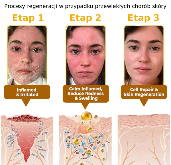 „Zakazane” odkrycie natury, które usuwa lata uszkodzeń skóry i kończy codzienną walkę z łuszczycą, zmarszczkami i przewlekłymi chorobami skóry.